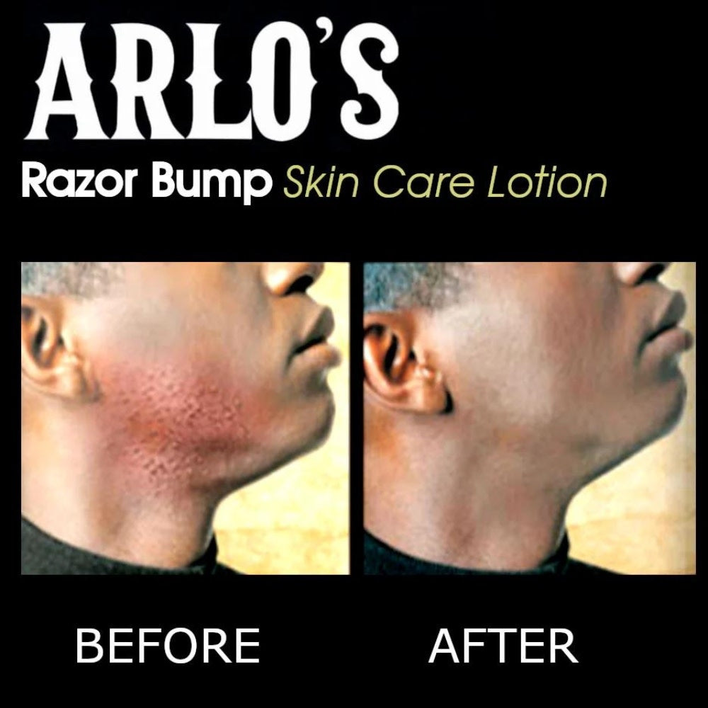 Razor Bump Skin Care Lotion (177ml/6.0oz)
